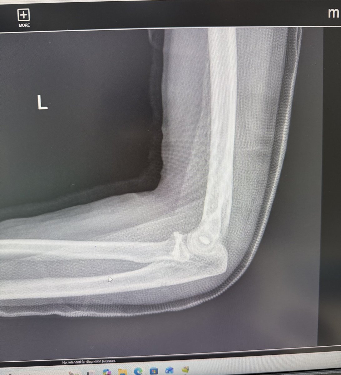 slemanORTHO's tweet photo. Terrible Triad Injury of Elbow https://t.co/rqEOb5Oh7w
