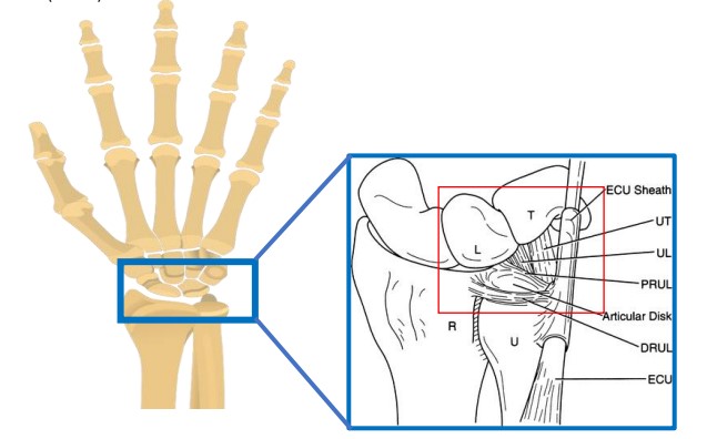 NickIlic_Physio's tweet image. Q: “How do you manage #TFCC injuries?”

My usual response: “How do you know it’s TFCC?”

Confirmed TFCC tears are rare. MRI often isn't clear.
The specific "TFCC" diagnosis usually doesn’t change management, but it can be nocebic vs "Ulnar Wrist Pain".

🔗 nickilicphysio.substack.com/p/clinicians-c…
