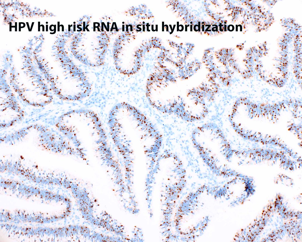 Distal rectal polyp - HPV-associated glandular neoplasms are rare and mimic tubulovillous adenomas. The mucin is peculiar and apical apoptotic bodies can be plentiful (arrow). 

Voltaggio L, et al. Mod Pathol. 2020 May;33(5):944-952. PMID: 31857682.