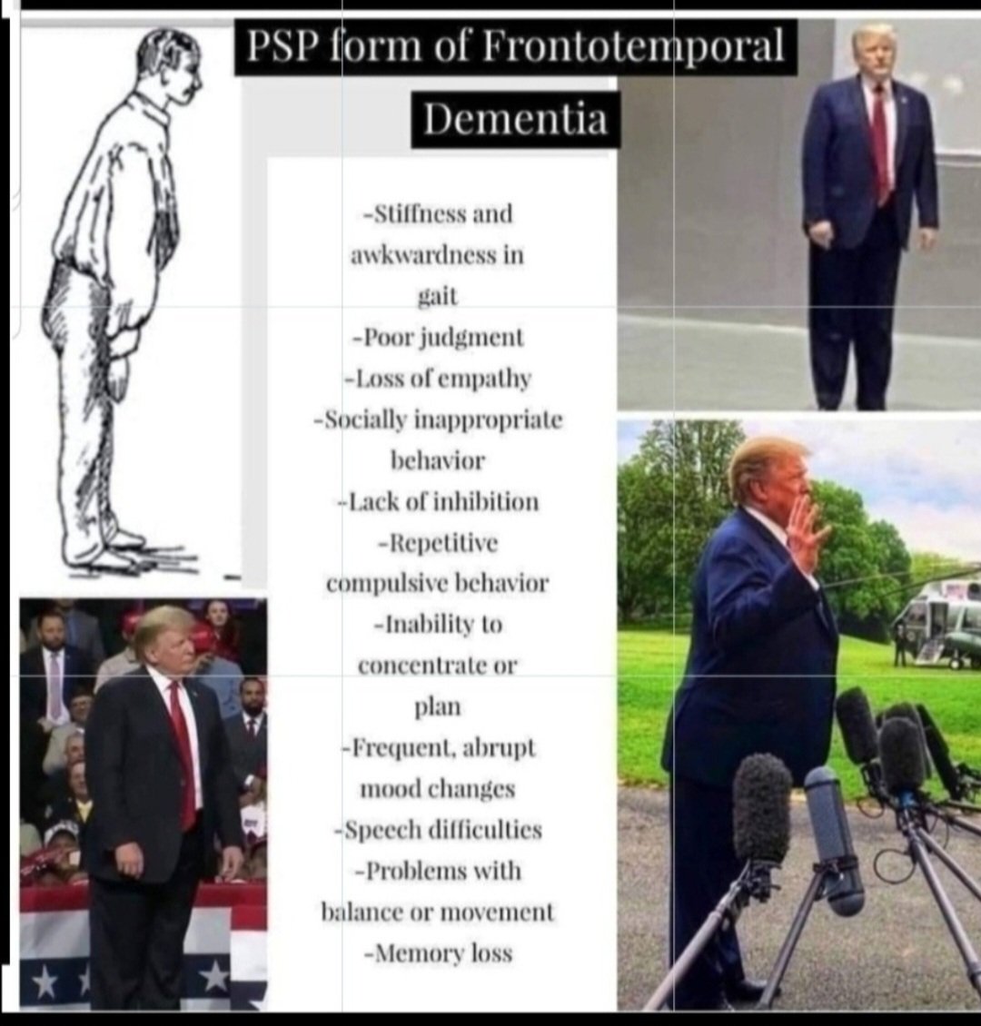 <a href="/jimstewartson/">Jim Stewartson, Decelerationist 🇨🇦🇺🇦🇺🇸</a> He wasn't very smart to begin with. He's quite brain damaged with some serious mental disorders. He has frontal lobe damage and executive dysfunction
He has now got dementia. It's possible frontotemporal dementia. I also suspect tertiary syphilis.