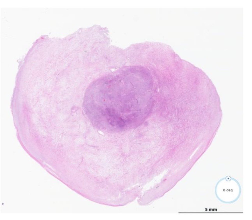 DrBuiPathology's tweet photo. #DrBuiBSTCaseCollection    This is a hybrid Schwannoma and neurofibroma.                     #pathX #pathtwitter ⁦@MoffittNews⁩ ⁦@USFpathology⁩ ⁦@CAPA_comm⁩ https://t.co/bvtB6BrkeX