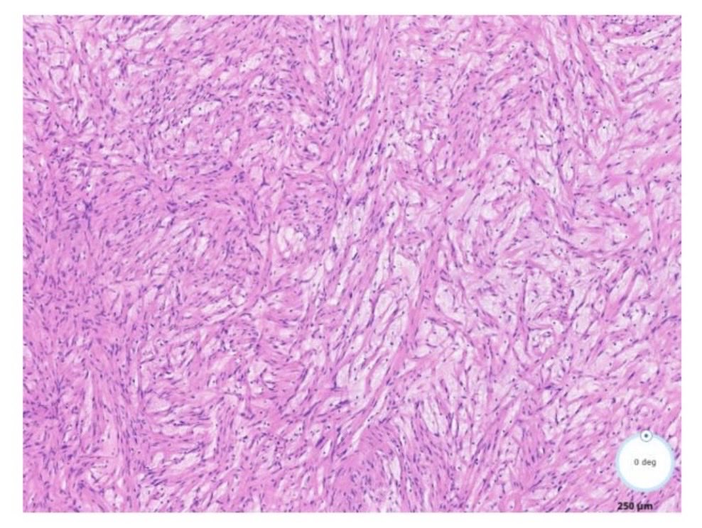 DrBuiPathology's tweet photo. #DrBuiBSTCaseCollection    This is a hybrid Schwannoma and neurofibroma.                     #pathX #pathtwitter ⁦@MoffittNews⁩ ⁦@USFpathology⁩ ⁦@CAPA_comm⁩ https://t.co/bvtB6BrkeX