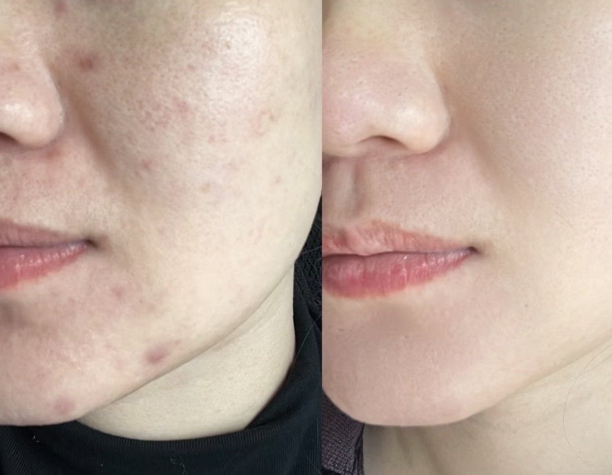 meauwww11's tweet image. Thanks to dr. Tompi &amp;amp; para warga

dlu gak kepikiran beli krn ngerasa mahal, skrng malah yg bikin kulitku pulih stelah trauma skincare hype.

sejak konsisten basic skincare ini, aku brhenti FOMO skincare hype
herannya malah lbh hemat

Micelar water: Wardah 
Face wash: Cetaphil
…