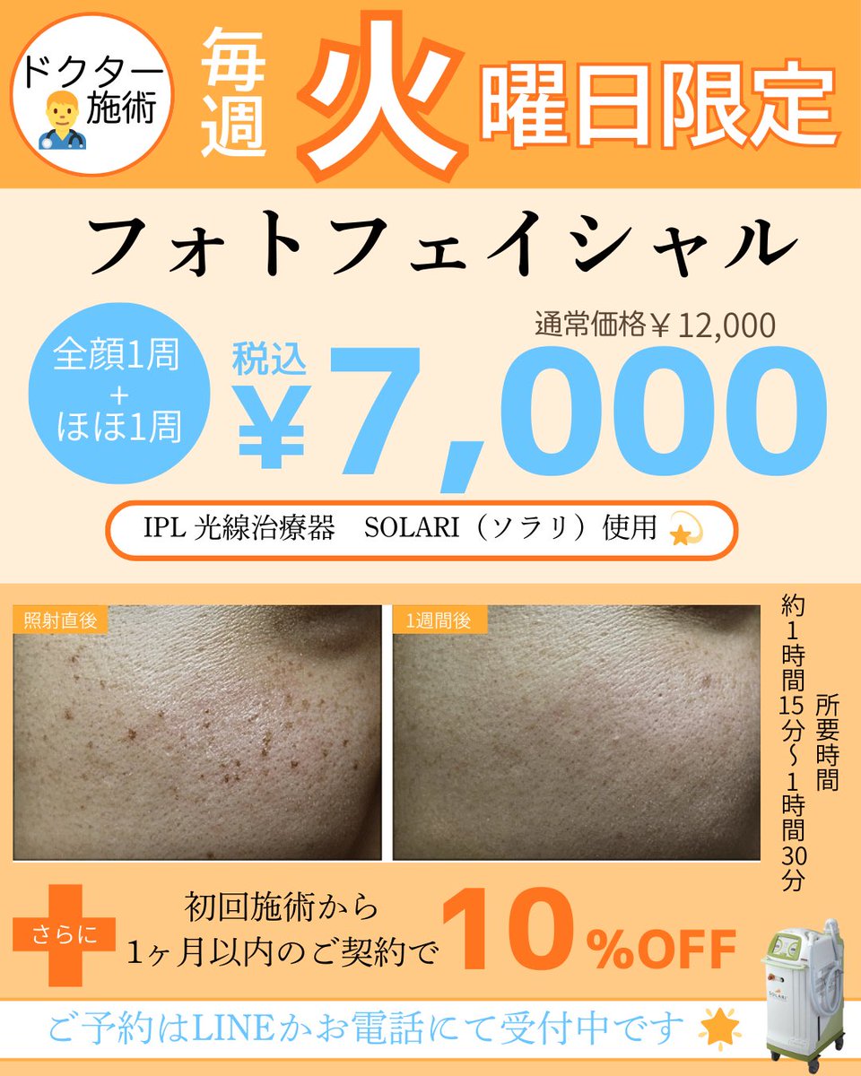 dr_matsui's tweet photo. 毎週火曜日限定メニュー
人気のフォトフェイシャルが￥7,000（税込）でご案内可能です。
蓄積したシミやそばかすを浮かせて剥がす。
マスクで隠せるこの時期におすすめの施術です。 https://t.co/MPDgSSPRv5