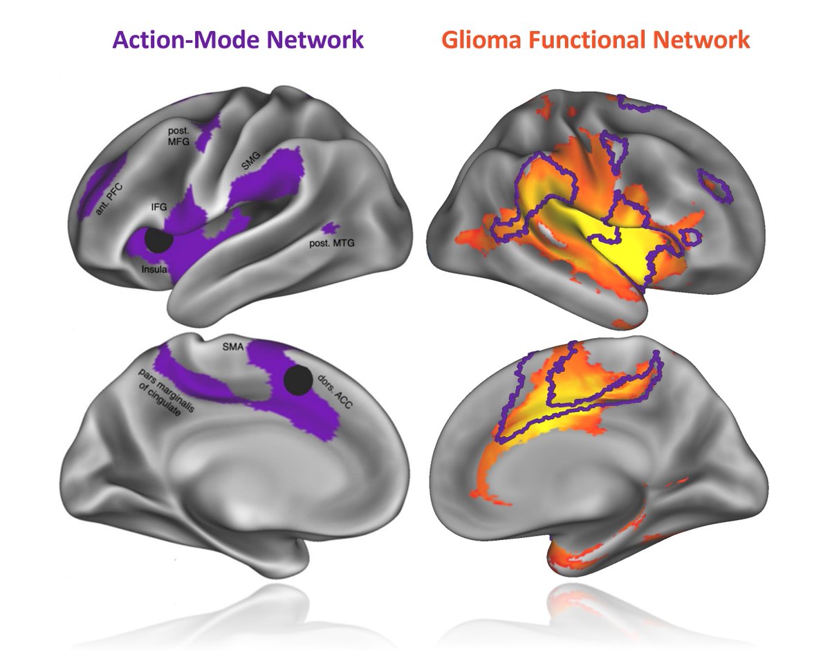 Gliomas do not develop randomly but prefer a specific network: the action mode network -- no matter the tumors are in the cortex or cerebellum. This suggests action-related functional activity may play a key role in tumor growth.  <a href="/ndosenbach/">Nico Dosenbach</a> <a href="/foxmdphd/">Michael Fox</a>  

biorxiv.org/content/10.648…