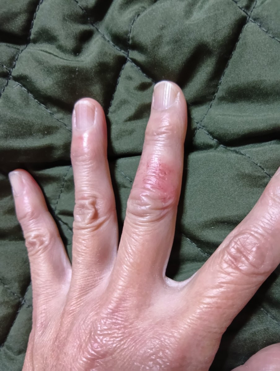 今🏥皮膚科が開いていたので行って来ました自分でビックリしました凍傷シモヤケだそうです😱😨私手の指のシモヤケなんて初めてです😥🏥での治療は赤外線をあてただけです