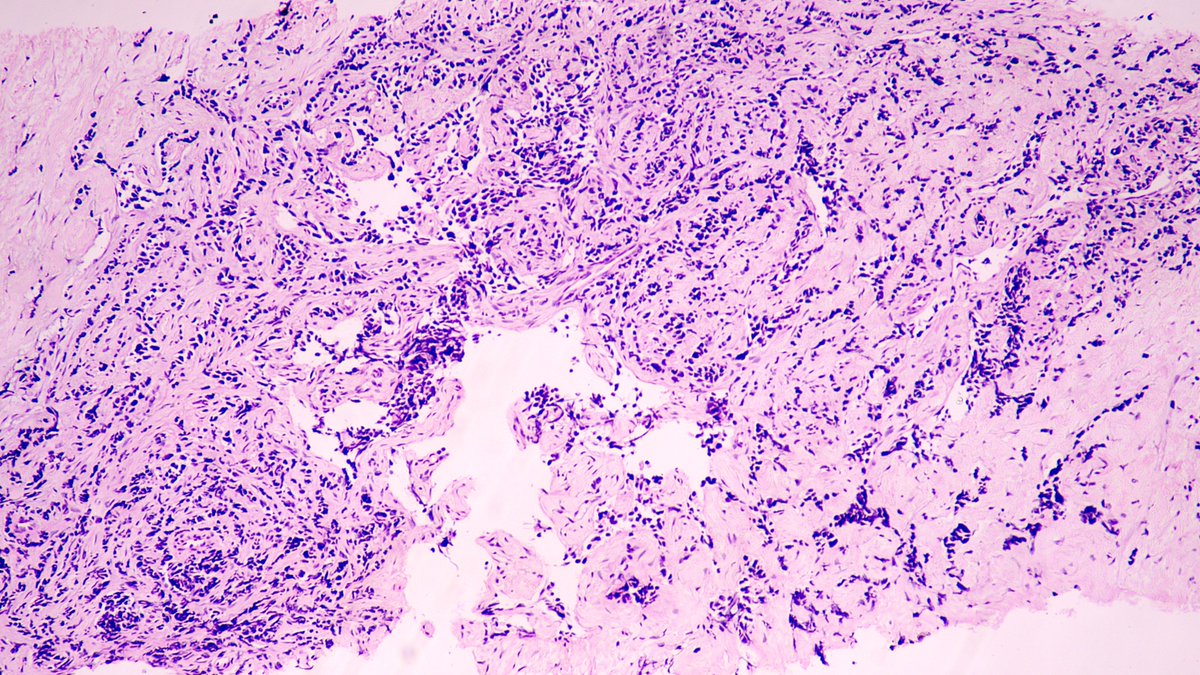 Middle-aged male. Peritoneal nodules. #PathX #PathTwitter #SurgPath