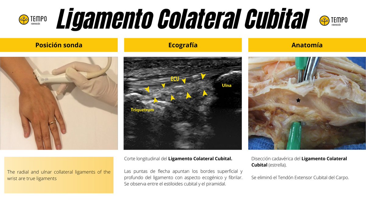 Extraído del artículo The radial and ulnar collateral ligaments of the wrist are true ligaments de Tolga Tülker et al.