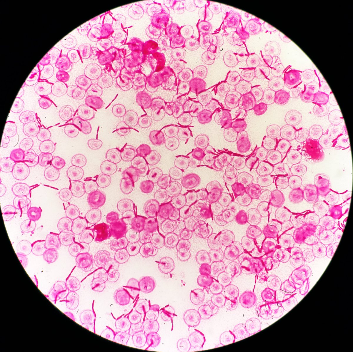 candyca88328815's tweet photo. Escherichia coli  尿　
発熱時に抗菌薬SBT/ABPC投与。翌日尿培養,血液培養採取。翌々日尿は1分画目発育せず塗沫には菌塊。血液培養の塗沫は伸びたGNR→報告後感受性結果を待たずMEPM,TEICに変更。後日結果を見てCEZに切り替え。1回でも抗菌薬入るとこうなる。 https://t.co/eX9ZqJtaHc