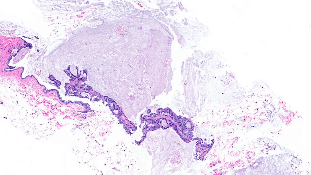 RazaHoda's tweet image. Case of Atypical Ductal Hyperplasia (ADH) in Mucocele-Like Lesion 🍪🔬

☑️ Dilated ducts with extravasated mucin
☑️ Foci of ADH lining mucin-filled spaces
☑️ Upgrade rate to DCIS/invasive carcinoma is 20-40%

#PathX #PathTwitter #breastpath