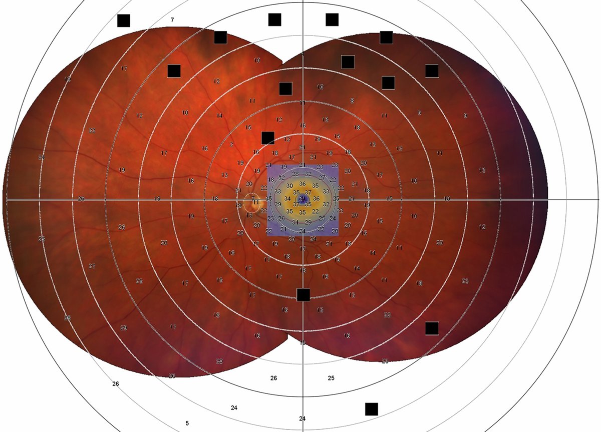 AAOjournal's tweet image. Visual Field Estimation in X-Linked Retinitis Pigmentosa associated with RPGR from Image Analysis using Artificial Intelligence
ow.ly/BKAm50XHpww
#ophthalmology