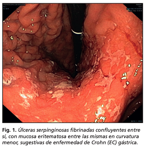 Imagen en patología digestiva <a href="/REEDigestivas_/">Revista Española Enfermedades Digestivas (REED)</a>

📖Enfermedad de Crohn: más allá del intestino

🔗 reed.es/enfermedad-de-…

🔓#OpenAccess

✍️ <a href="/pablolcina/">Pablo Olcina</a> et al