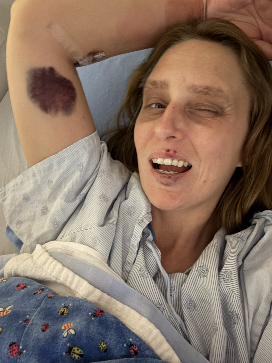 katynotie's tweet image. Hi friends!
I died for a bit. For reals. But I came back.
Full cardiac arrest. Healing up well!