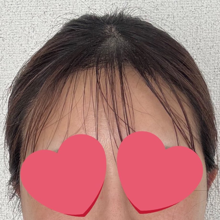 rurexx's tweet photo. 〖 術後21日目〗

2週間経過。後ろでくくって前髪をおろした状態。前髪の隙間からしっかりと生え伸びたヘアラインが覗いてます。ヘアラインがすごい痒いけど我慢。もみあげも伸びて元気よく外に向けて飛び出てます。(前髪散らかっててごめんなさい🙏🏻) https://t.co/xJiJJrMEWv