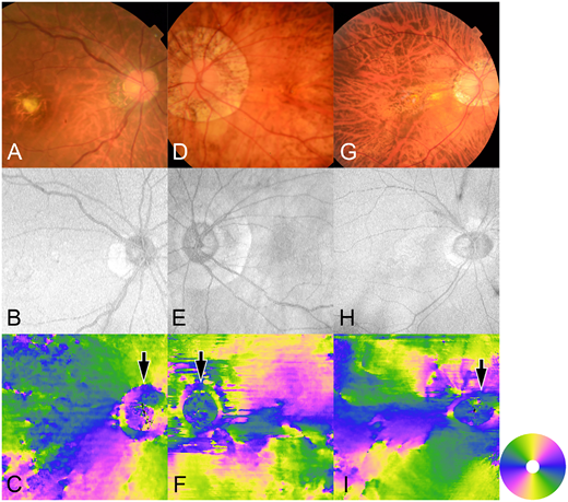 ARVOiovs's tweet photo. Kyoko Ohno-Matsui et al. from the Institute of Science, Tokyo determine the structural characteristics of the peripapillary sclera in myopic eyes using polarization-sensitive optical coherence tomography. 
https://t.co/ody1QHvsh9 https://t.co/ar1aURZC07