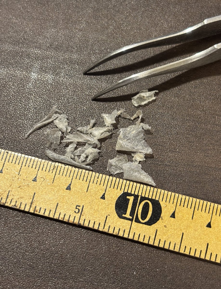 元サイズに戻ってきた耳介の皮が日焼けの後みたいにぺろんぺろん剥けてきておもろwww それこそ軽い火傷みたいなもんなんだな。外因か内因かの違い はあるけども。