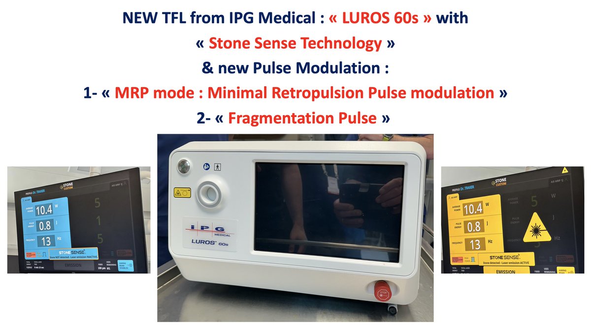 OTRAXER's tweet photo. BN179: INDIA, Dec.19th-2025 very privileged to perform the very first Clinical evaluation of the new TFL Laser of IPG Medical : «The TFL LUROS 60s ». With new STONE SENSE- MRP (Minimal Retropulsion pulse) and New Fragmentation Pulse modulation: 20 to 30 J and 1Hz for kidney stone https://t.co/FE0VvSxkCK