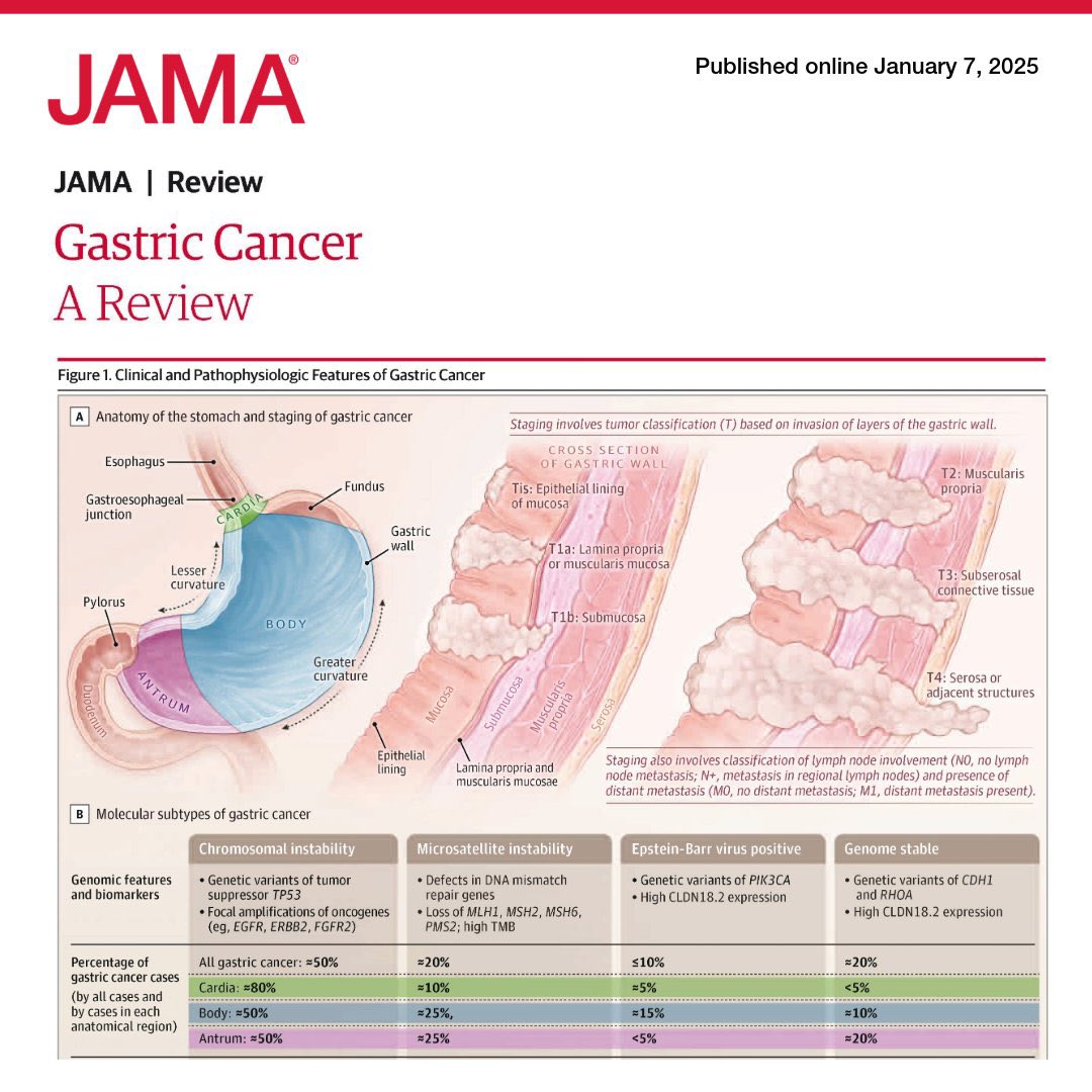 DraMartinezLago's tweet photo. 🟣 Gastric cancer in 2025 — essentials
🌍 ~1M new cases/year; high mortality
🦠 H. pylori remains a key, treatable risk factor
🎯 Localized: surgery ± perioperative chemo-IO
🧬 Metastatic: chemo + IO/targeted therapy
🤝 Early supportive care matters

🔗 https://t.co/IiSgIlIKvD https://t.co/OeiRk8vsfm