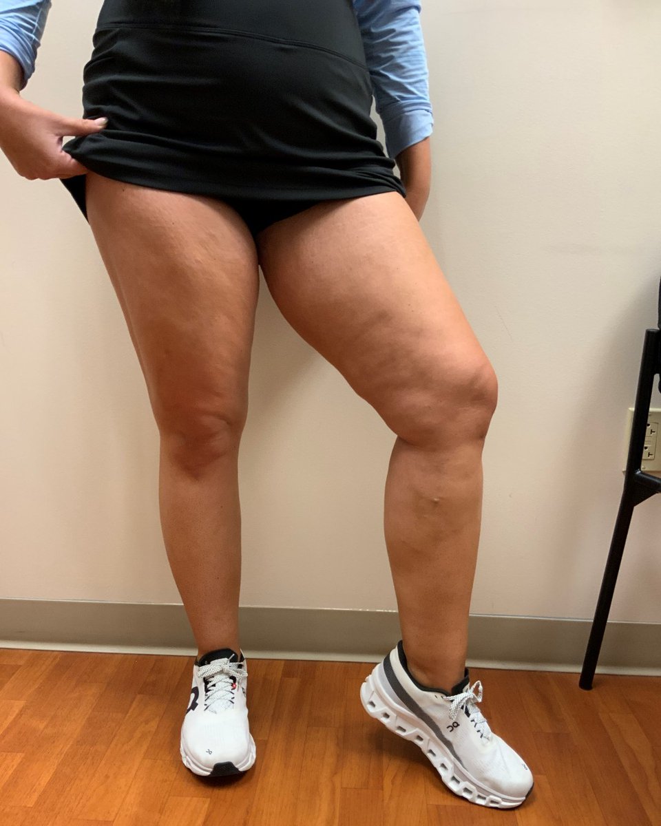 LaserVein's tweet image. 🌟 New Year, New Relief 🌟
Start 2026 feeling lighter, more energized, and free from leg discomfort. Our vein treatments help you step confidently into the year ahead. ❄️💙
📞 Schedule your New Year consultation: 636-614-1665

#VeinTreatment #BeforeAfter #LLVC