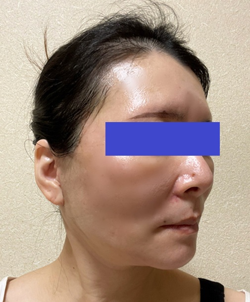 kiko 切開リフトDT中 tweet media