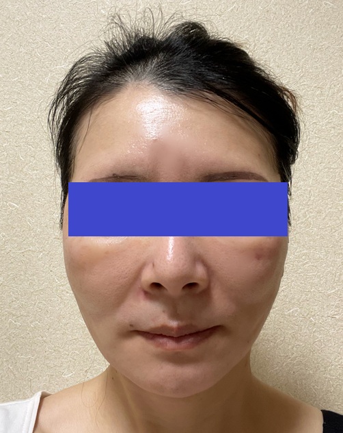 kiko 切開リフトDT中 tweet media