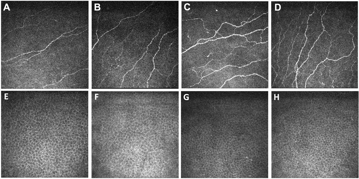 AAOjournal's tweet image. The Association among Corneal Nerve Metrics, Ocular Surface Integrity and Renal Function in Type 2 Diabetes
ow.ly/MtyM50XHpy9 
#ophthalmology