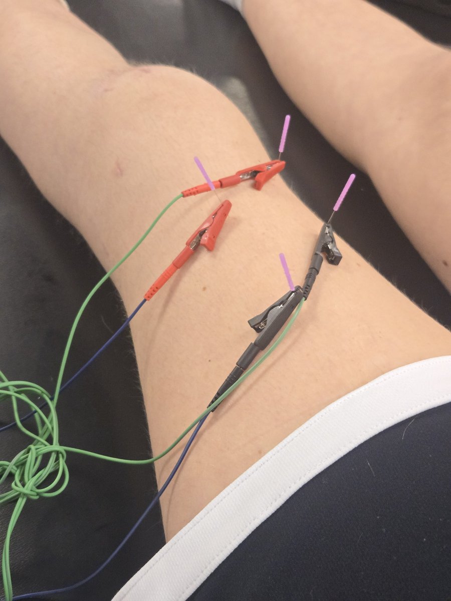BrooklynnSnow09's tweet photo. Got some dry needling done for the first time.  Felt super weird but very helpful!!
@FosterWbball #PTN https://t.co/xjiBVSyqq4