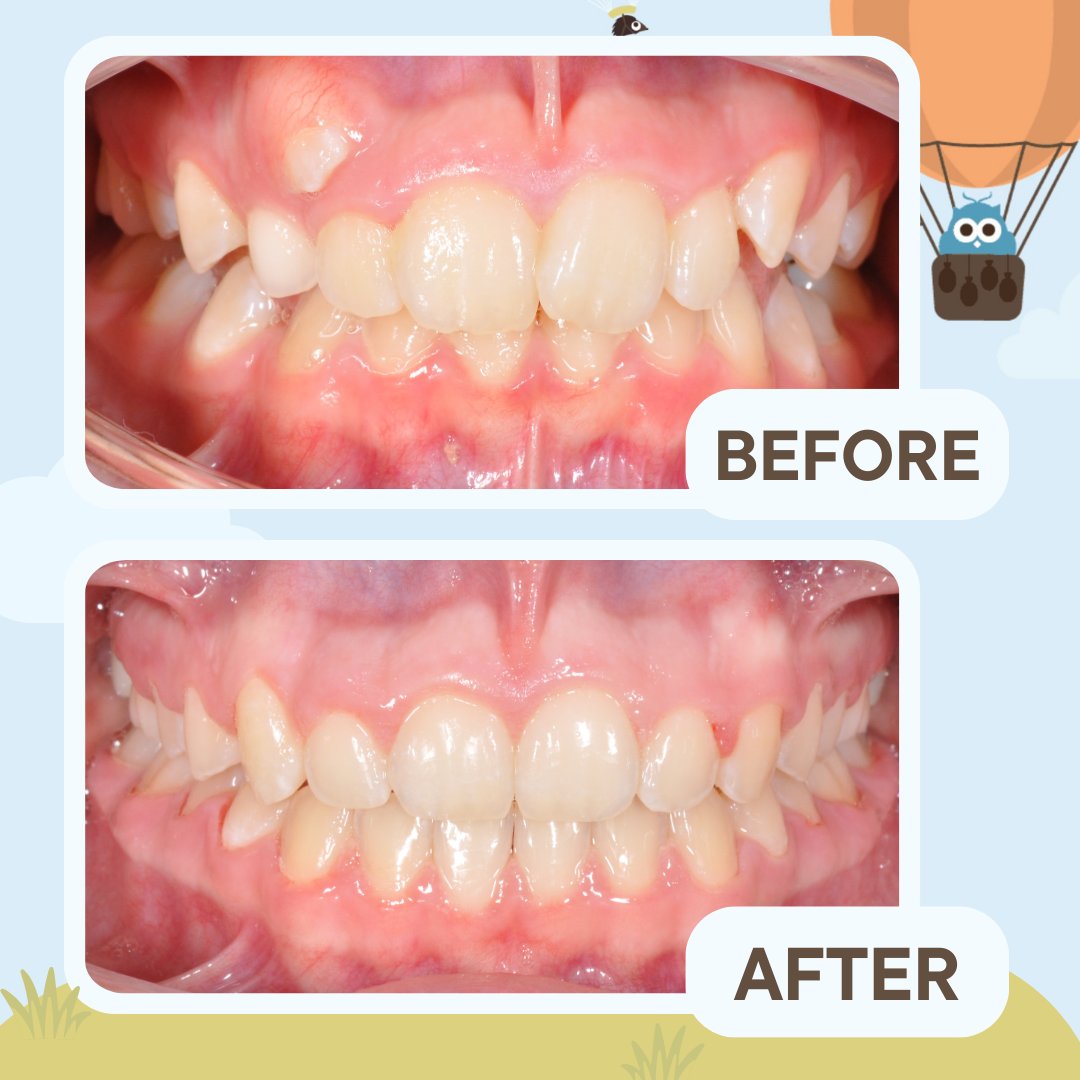 HughesCozad's tweet image. Orthodontic care that grows with you! At 12 years old this patient has just completed 22 months of treatment that entailed upper and lower braces with elastics and custom sure smile wires. 

💻 Website: HughesCozadOrtho.com

#SmileTransformation #Braces #Orthodontics