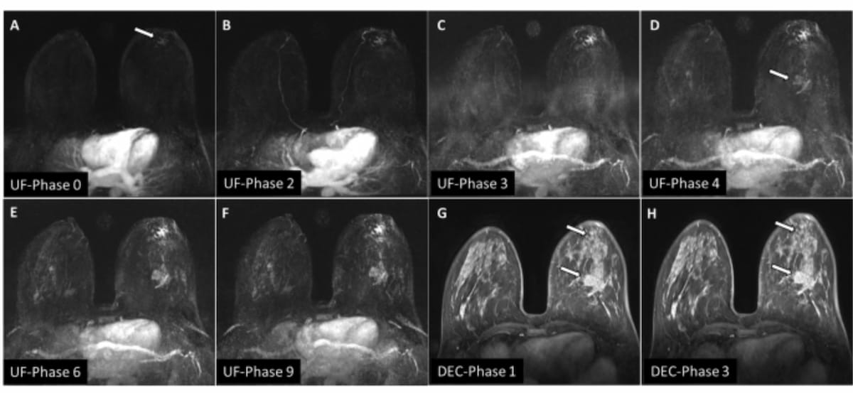 What New Prospective Research Reveals About Ultrafast Breast #MRI
diagnosticimaging.com/view/new-prosp…
<a href="/RadiologyACR/">American College of Radiology</a> <a href="/ARRS_Radiology/">ARRS</a> <a href="/RSNA/">RSNA</a> <a href="/BreastImaging/">Society of Breast Imaging</a> <a href="/SBIRFS/">SBI RFS</a> <a href="/UCSFimaging/">UCSF Imaging</a> <a href="/MayoRadiology/">Mayo Clinic Radiology</a> <a href="/OHSURadiology/">OHSU Radiology</a> <a href="/StanfordRad/">Stanford Radiology</a> <a href="/RadiologyUSC/">Radiology of USC</a> <a href="/RadiologyUcla/">UCLA Radiology</a> <a href="/UCSDRadMed/">UC San Diego Rad Med</a> 
#radiology #RadRes