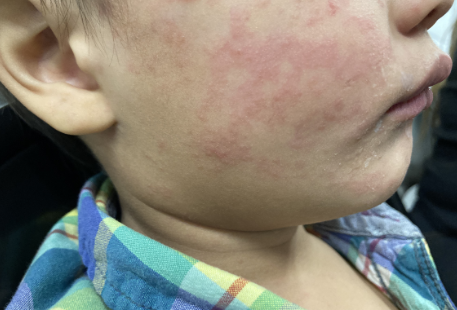 bactiman63's tweet image. The #NorthCarolina Department of Health and Human Services and Buncombe County Health and Human Services (BCHHS) Division of Public Health announced additional cases of #measles in three siblings in Buncombe County. The family had visited #Spartanburg County, #SouthCarolina,