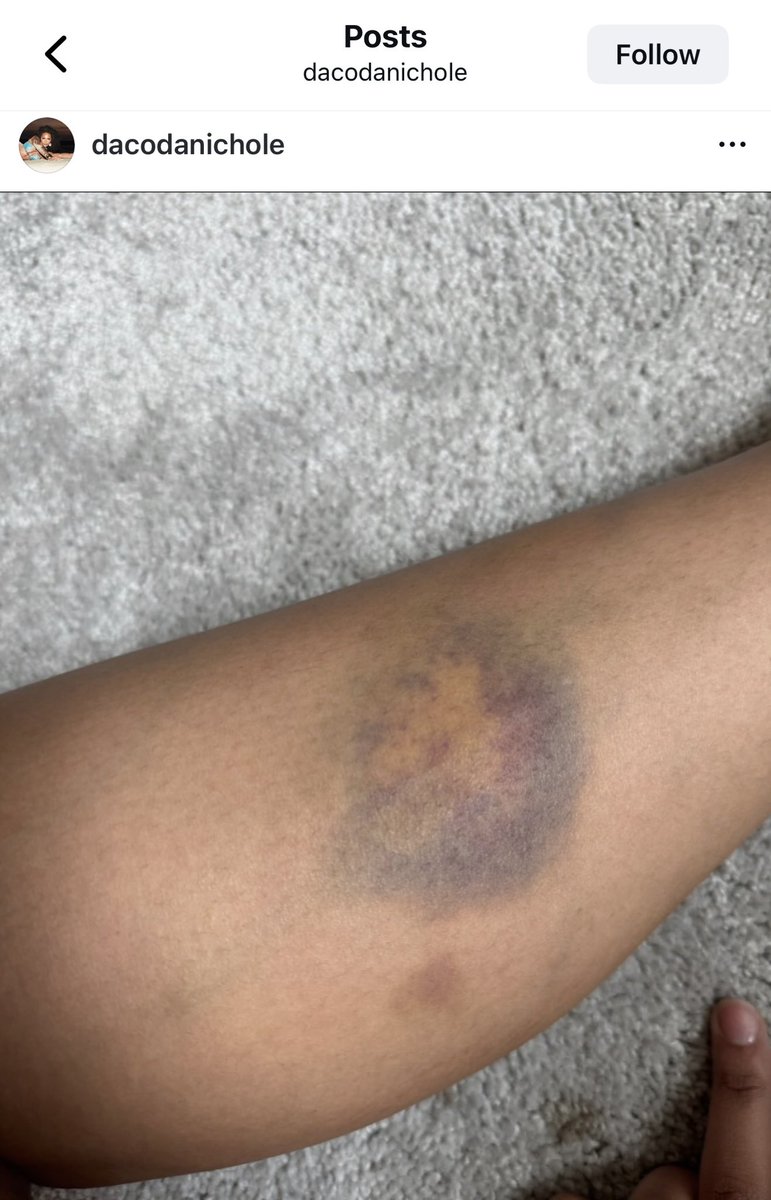 MLFootball's tweet image. 🚨🚨BREAKING NEWS: WARNING🚨🚨

#Chiefs star wide receiver Rashee Rice’s ex-girlfriend Dacoda Nichole has accused him in an Instagram post of 8 years of domestic abuse, alleging ongoing violence, including while she was pregnant.

She says she is no longer protecting his image…