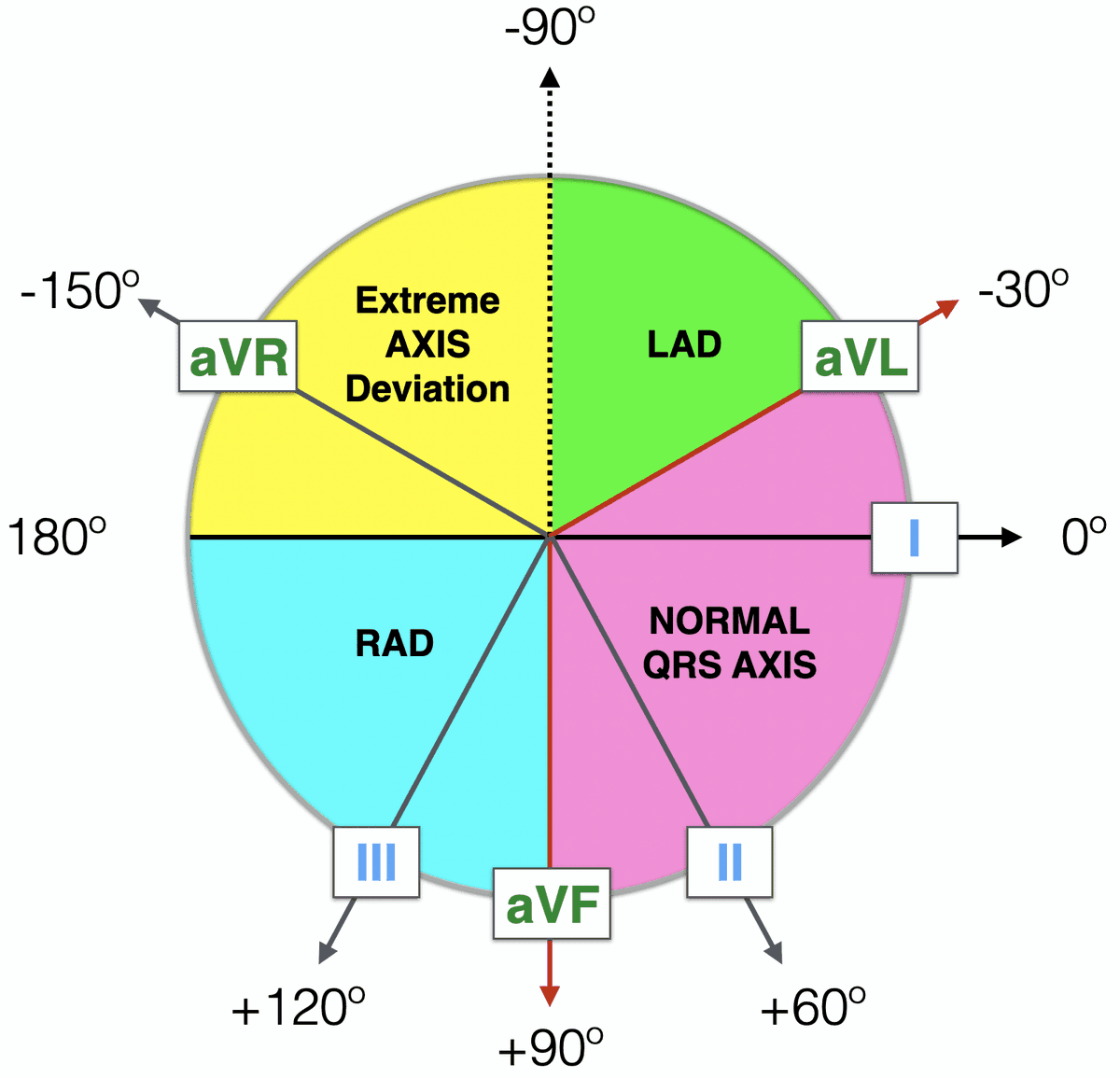 RitikaTuliMD's tweet photo. #CardioNugget: 

“Northwest Axis” = Clue for VT

What it is:
✅ Extreme axis deviation (“northwest axis”) 
 QRS positive in aVR and negative in Lead I + aVF.

How to spot it fast:
Look at I and aVF: both negative → axis is “northwest”
Confirm: aVR is upright

Why it favors VT:
SVT with aberrancy usually still uses the His–Purkinje system, so the axis is often more “physiologic.”

VT activates the ventricles from myocardium, spreading in an abnormal direction → can drive the net vector superior/rightward → upright aVR + negative I/aVF.

#CardioNugget #MedEd #CardioTwitter