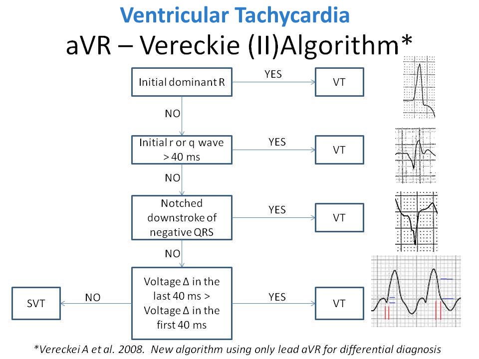 RitikaTuliMD's tweet photo. 🫀 CardioNugget: V

ereckei (aVR) Algorithm for Wide-Complex Tachycardia

Goal: Is this VT or SVT with aberrancy?

Physiology key: SVT usually has a fast start (His–Purkinje early). VT often has a slow/fragmented start (myocardium-first).

Step through lead aVR (in order):
1) Initial R in aVR? → VT
The vector suggests ventricular origin.

2) Initial r or q ≥ 40 ms in aVR? → VT
“Slow start” = cell-to-cell myocardial activation.

3) Notching on the initial downstroke of a predominantly negative QRS in aVR? → VT
Fragmented early conduction (scar/anisotropy) vs smooth Purkinje.

4) Vi/Vt ratio (first vs last 40 ms of QRS in aVR):
Vi/Vt ≤ 1 → VT (slow early, relatively faster late)

#CardioNuggets #MedEd #EPeeps #CardioTwitter