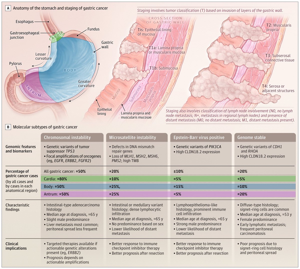 Gastric Cancer: A Comprehensive Update (JAMA, 2026) Gastric cancer