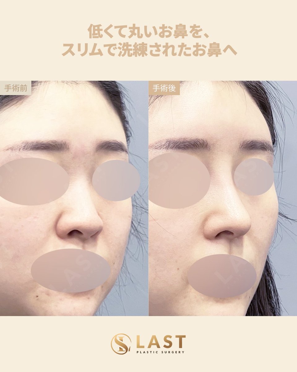 ✨鼻整形症例紹介｜ラスト美容外科 ✨ 📍執刀医：チェ・ジェホ代表院長