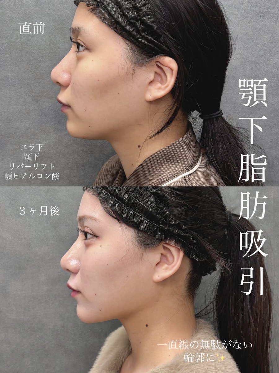dr__kiya's tweet photo. 【顎下脂肪吸引３ヶ月後経過】
顎ヒアルロン酸も併用してより綺麗な一直線の横顔に✨
脂肪吸引注射で理想の仕上がりにならず脂肪吸引を決意された患者様です。何もしてない方よりは吸引しづらい事もありますがしっかり綺麗な横顔に仕上げました🙏 https://t.co/4IRZkav2AW