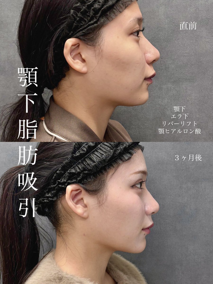 dr__kiya's tweet photo. 【顎下脂肪吸引３ヶ月後経過】
顎ヒアルロン酸も併用してより綺麗な一直線の横顔に✨
脂肪吸引注射で理想の仕上がりにならず脂肪吸引を決意された患者様です。何もしてない方よりは吸引しづらい事もありますがしっかり綺麗な横顔に仕上げました🙏 https://t.co/4IRZkav2AW