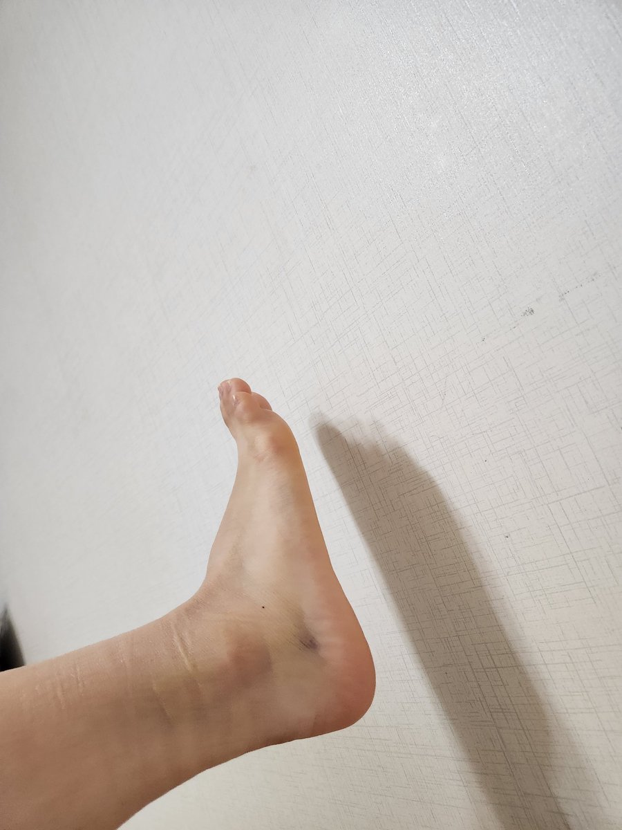붕대 푸니까 인대 늘어난 부분따라 피멍이...ㄷㄷ