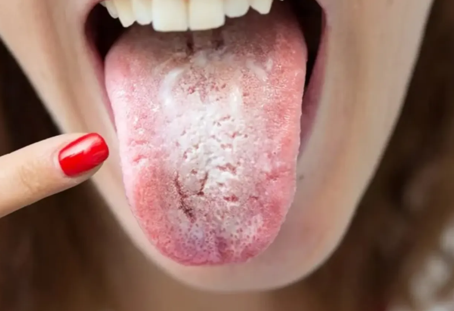 الذكاء الاصطناعي يشخّص السكري وسرطان المعدة من لون اللسان 