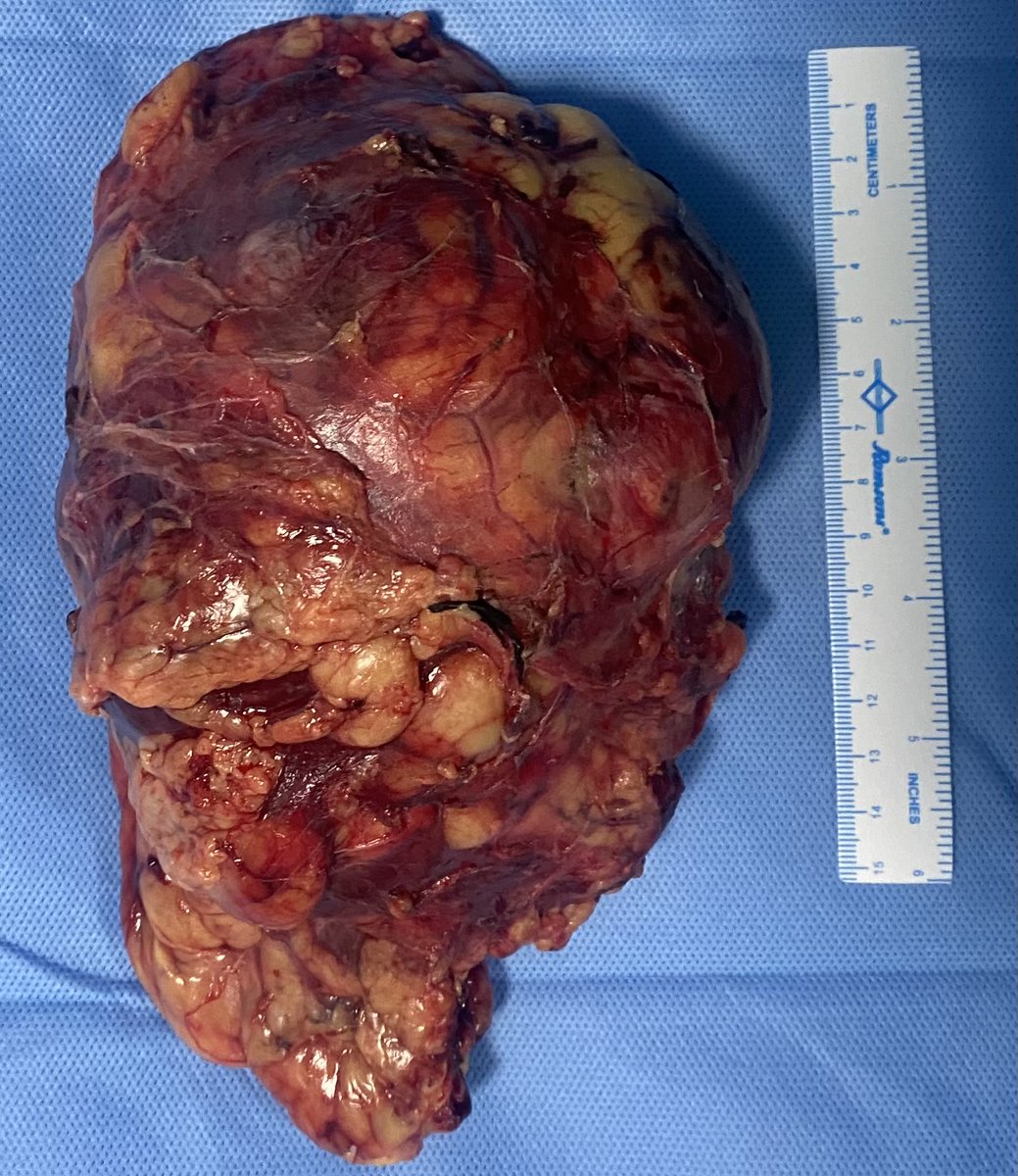 drrobinbasnet's tweet photo. RCC with renal vein thrombus … this guy was being treated for varicocele !!! https://t.co/am1FTqnfKs