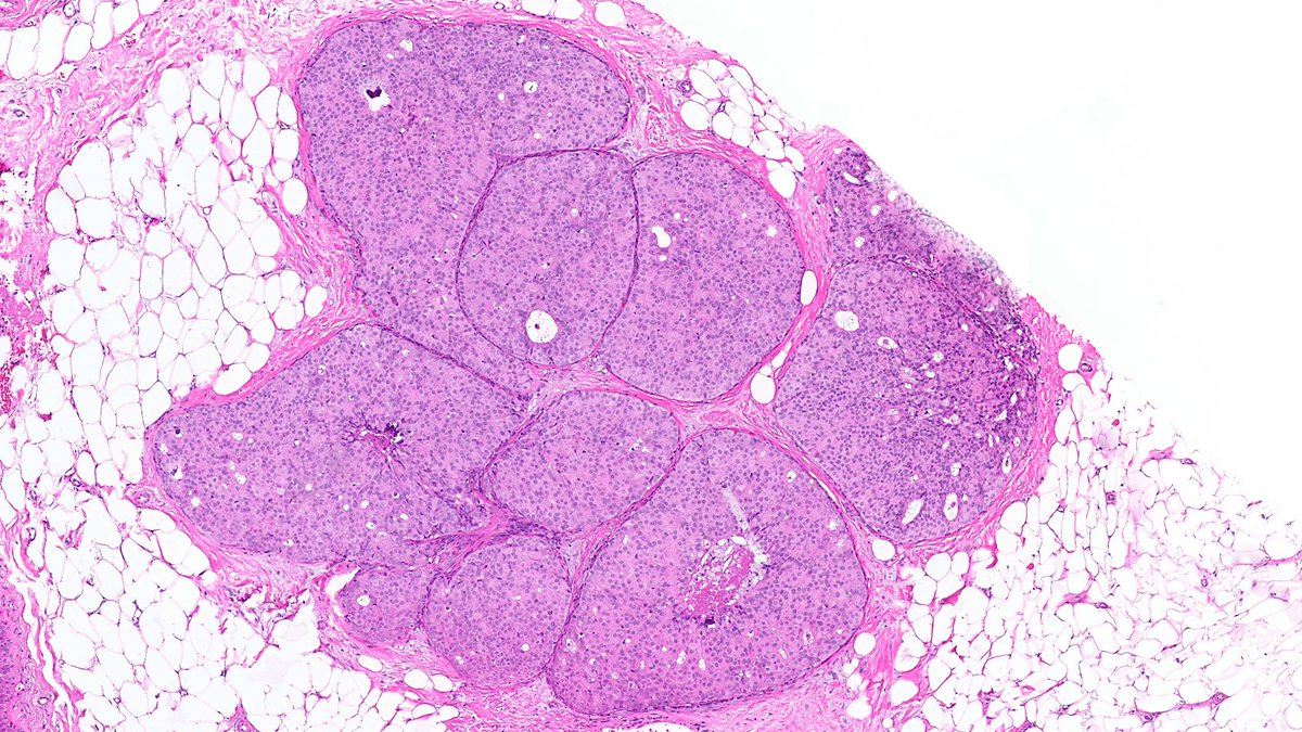 RazaHoda's tweet image. Case of Ductal Carcinoma In-Situ (DCIS) 🍪🔬

☑️ Neoplastic epithelial proliferation confined to ducts and lobules
☑️ May show variety of architectural patterns, like solid and cribriform 👇
☑️ Graded by nuclear atypia

#PathX #PathTwitter #breastpath