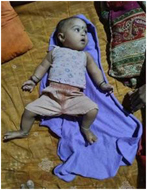 ડભોઇ તાલુકાના નાગડોલ ખાતે ડિલિવરી થતાં RBSK ટીમ દ્વારા મુલાકાત કરીને બાળકની તપાસ કરતાં બાળકને ક્લબફુટની જન્મજાત ખોડખાંપણ હતી જેને માતા-પિતા સાથે કાઉન્સેલિંગ કરીને DEIC માં સારવાર કરવામાં આવેલ. હાલ બાળકના પગ સામાન્ય થયેલ છે.
<a href="/ddo_vadodara/">District Panchayat Vadodara</a> <a href="/Info_Vadodara/">Info Vadodara GoG</a> <a href="/GujaratSHRBSK/">Gujarat SH (RBSK) Rashtriya Bal Swasthya Karyakram</a>