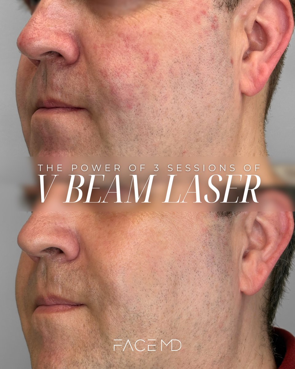 CandelaMedical1's tweet photo. A standout result after three Vbeam® sessions, achieved by the expert team at Clinique Face MD.
Clear improvement in facial redness and vascular lesions, with a calmer, more even complexion visible across both face and profile.
#CliniqueFaceMD #Vbeam #PulsedDyeLaser #Vascular https://t.co/XlltJiqhOS