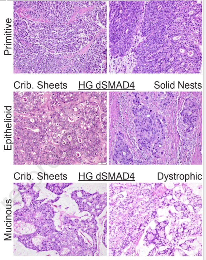 YMirzabeigi's tweet image. I’m thrilled to share that our study on SMAD4-deficient colorectal adenocarcinoma has just been published in Modern Pathology.

Grateful to my amazing mentor Dr. Oliver G. McDonald for his tremendous support 🙏🏻

@ModernPathology @LizMontgomeryMD @UMiamiPathology 

#GIPath #PathX
