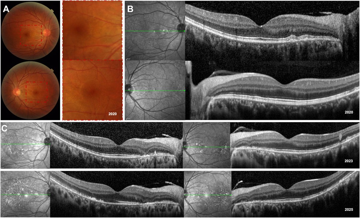 AAOjournal's tweet image. A 40-year-old man was referred for bilateral macular degeneration detected on routine examination. His best-corrected visual acuity was 20/20 bilaterally without visual complaints. A, Color fundus photography showed no crystalline deposits, but hyperreflective spots were visible…