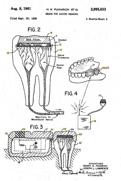 Dirg_rocketdyne's tweet image. 鉱石ラジオの原理で幻聴を拾う場合がある。銀歯ラジオと呼ばれるものだ。銀歯含有の組成が偶然ある状態になっていた場合、鉱石ラジオになり放送電波を拾ってしまう事態が稀に起こるらしい。…