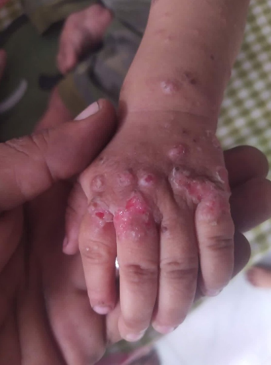 DONT SCROLLING PLS I BEG U

The skin disease has spread throughout my sis body. My heart aches to see her in pain She has been isolated from the children &amp; is in dire need of a transfer outside G@z@ for treatment
PLS DONATE PLS⬇️
gofund.me/401e9e0c
Or
paypal.me/mohajayyab