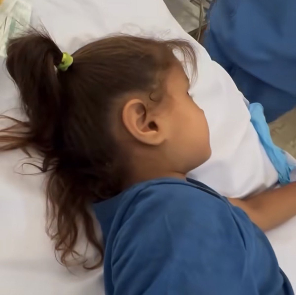 Emeliarjl's tweet image. Child Lana Al-Basous miraculously survives after being shot in the head by a drone-fired bullet.
The bullet lodged between her skull and scalp without penetrating.