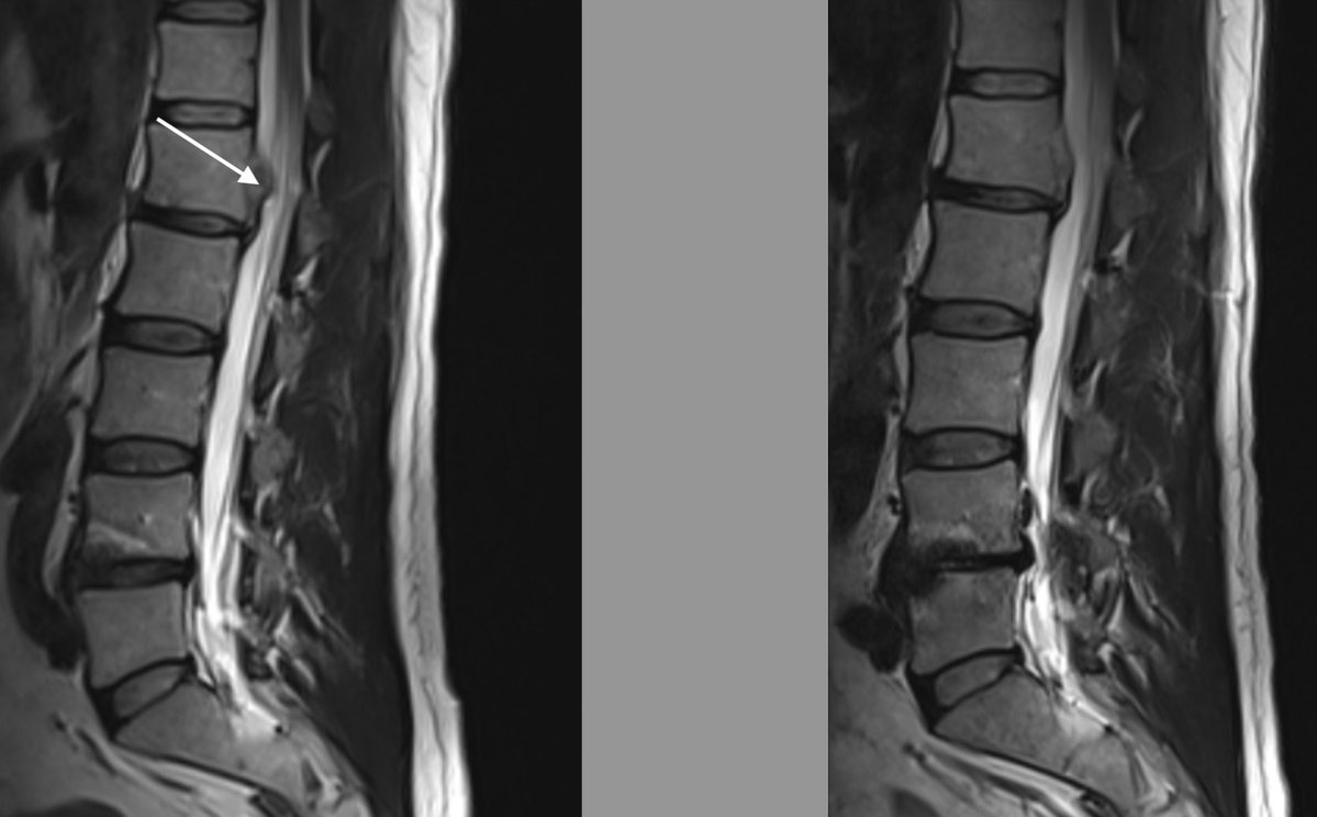 DrJN_SportsMed's tweet image. Consent✅(although it's me!)

Nice example of how even radiologically significant disc bulges can be clinically silent - and how they can regress / shrivel up over time

L1/2 disc extrusion causing right sided nerve root compression at 2 levels - but no upper lumbar pain,…