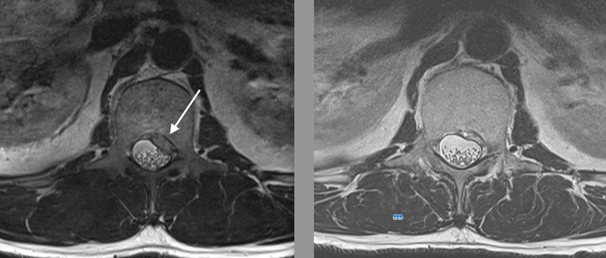 DrJN_SportsMed's tweet image. Consent✅(although it's me!)

Nice example of how even radiologically significant disc bulges can be clinically silent - and how they can regress / shrivel up over time

L1/2 disc extrusion causing right sided nerve root compression at 2 levels - but no upper lumbar pain,…